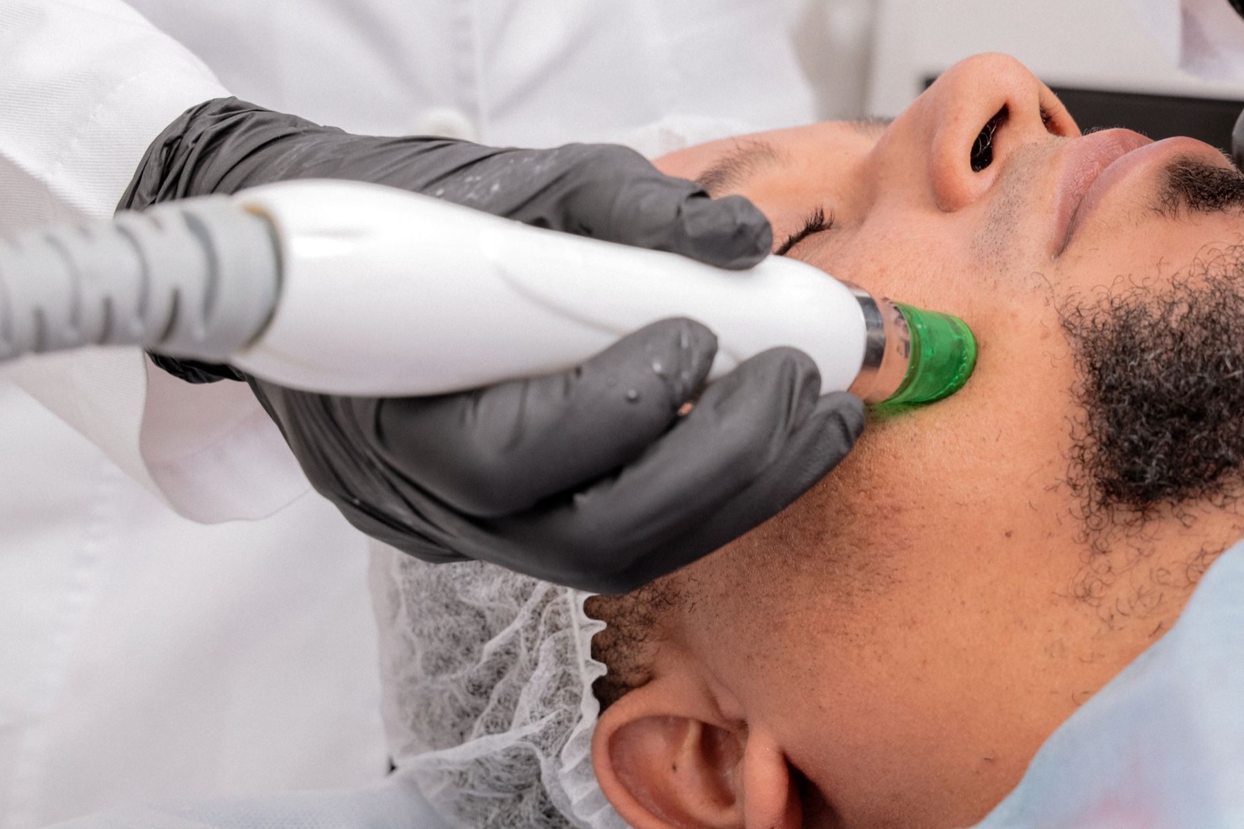 Microneedling
